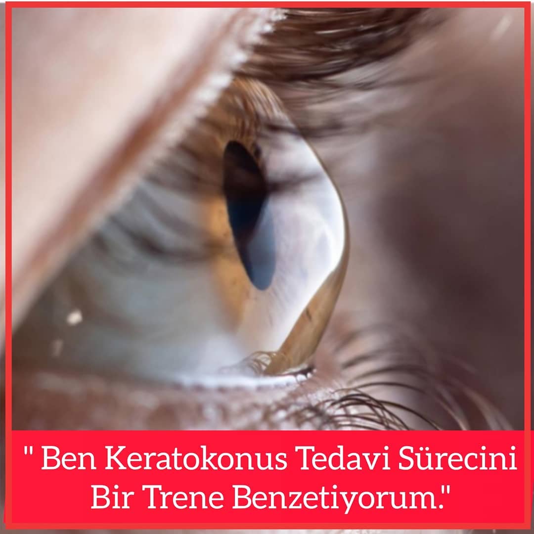 DrCoskunseven's tweet photo. Bizim trenimizin lokomotifi CCL adını verdiğimiz işte bu durdurma tedavisi.Bu lokomotife görmeyle ilgili bir vagon eklemek zorundayız.Keratokonuslu hastalar için çok güzel bir şekilde dizayn edilmiş Yarı sert, hybrid, scleral dediğimiz geniş çapta lensler bunlardan bazıları. https://t.co/DCQgCQRdLn