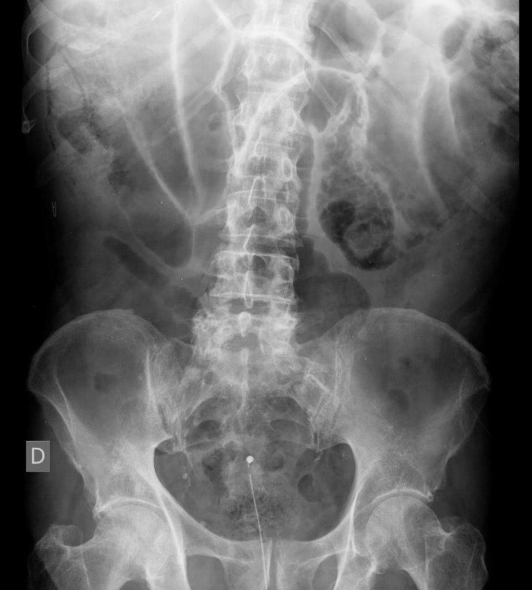 serammeA6SALUD's tweet photo. #CasosRAD_MOME @serammeA6SALUD 
Mujer de 80 años ingresada por ICC aguda descompensada. Estreñimiento y distensión abdominal de varios días, sin dolor ni defensa.
Se realiza Rx de abdomen en decúbito supino.
@damedium @residentesSERAM https://t.co/4lOpajyscn