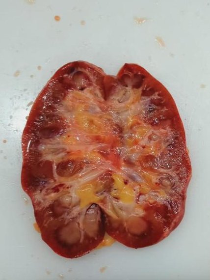 megha_lalcheta's tweet photo. Benign Nephrosclerosis of Kidney
#GUpath #Nephrosclerosis #PASstain
Prominent arteriolar hyaline change https://t.co/ZJo9lAbZ2V