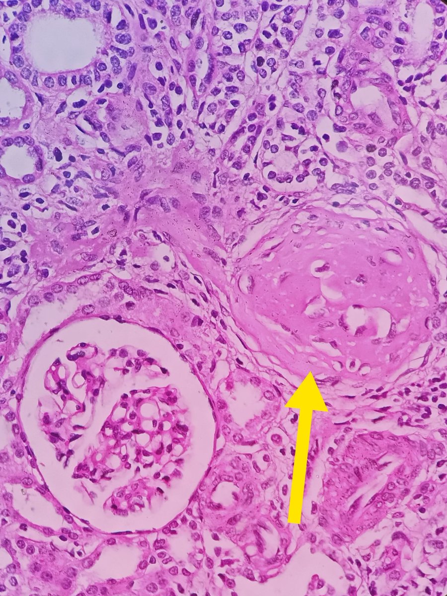 megha_lalcheta's tweet photo. Benign Nephrosclerosis of Kidney
#GUpath #Nephrosclerosis #PASstain
Prominent arteriolar hyaline change https://t.co/ZJo9lAbZ2V