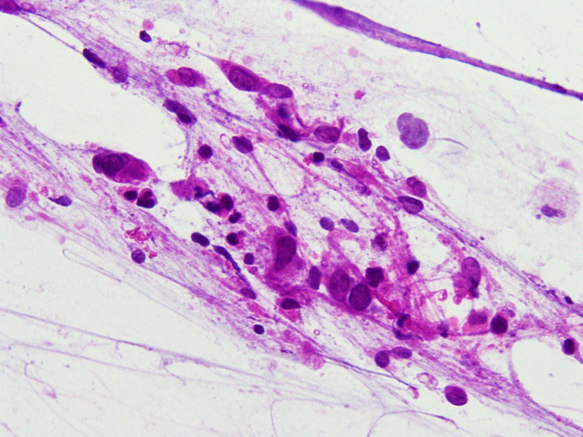 RegmiAayushma's tweet photo. Beautiful neuro case from my frozen week with Dr. @ewa_borys. @loyolapathology @Vijuananthan @KMirza @KMRN_MDLR @IUraizee3MD @MrMork87 @AlessaAragaoMD @iremessa @JasmineSaleh @BrandonZelmanDO @HHamnvag @aflevent @maryamraoufMD @CEKanakisMD @ElnazPanah @SandoraHaddad https://t.co/5VJwbNZELj