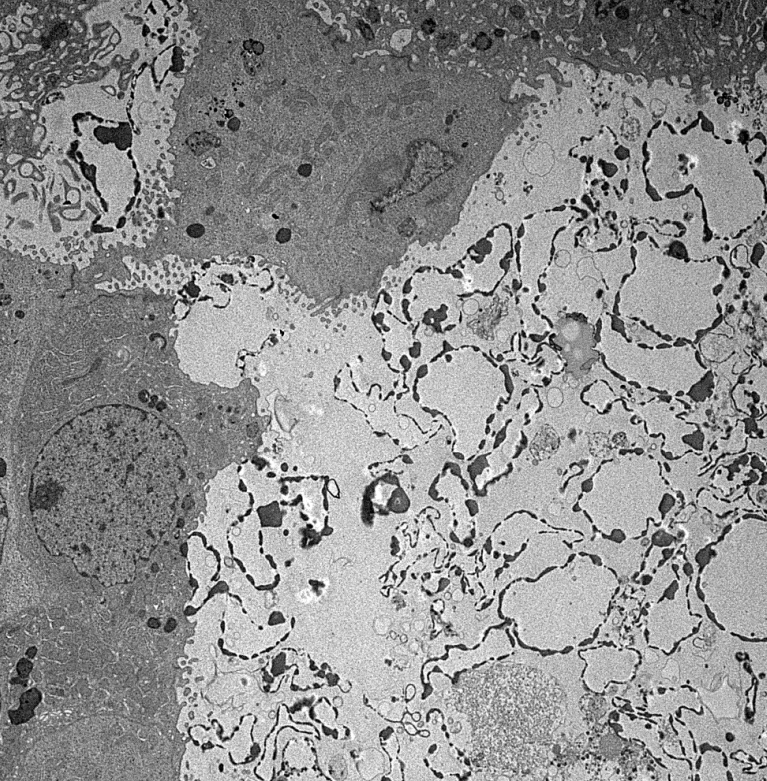JZRenalPath's tweet photo. Interesting EM findings in a case of ANCA GN. RBC ghosts in tubular casts. Neutrophil associated with GBM rupture and fibrin accumulation.  #renalpath #nephropath https://t.co/uaq44B0uKl