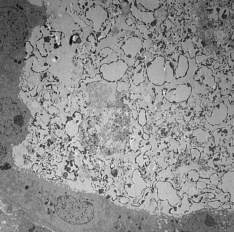 JZRenalPath's tweet photo. Interesting EM findings in a case of ANCA GN. RBC ghosts in tubular casts. Neutrophil associated with GBM rupture and fibrin accumulation.  #renalpath #nephropath https://t.co/uaq44B0uKl