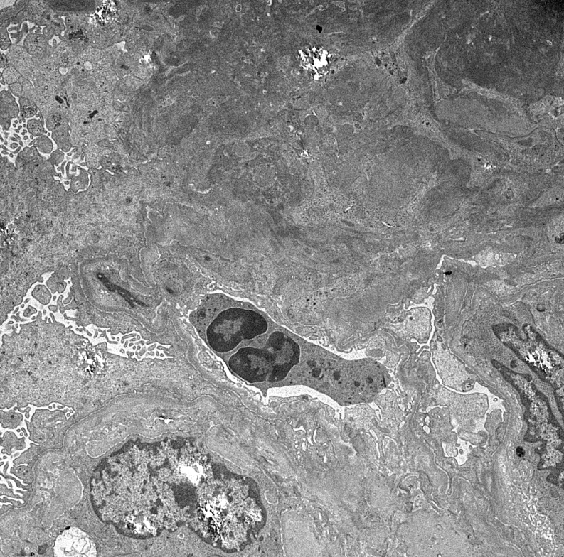JZRenalPath's tweet photo. Interesting EM findings in a case of ANCA GN. RBC ghosts in tubular casts. Neutrophil associated with GBM rupture and fibrin accumulation.  #renalpath #nephropath https://t.co/uaq44B0uKl