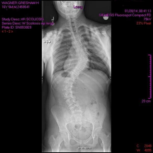 GlobalMX5Cup's tweet image. Mazda MX-5 Cup Opens Door That Scoliosis Closed for Gresham Wagner

Full story ⏩⏩ mx-5cup.com/news/mazda-mx-…