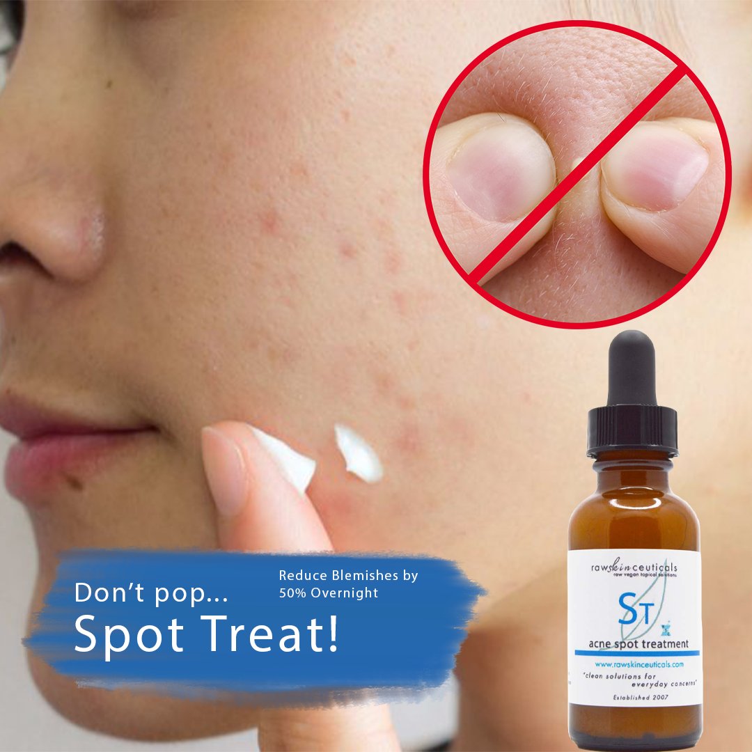 RSCeuticals's tweet photo. Don't pop, Spot Treat!! See why
⁠
Squeezing can push bacteria and pus deeper into the skin, which might cause more swelling and redness.
⁠
Our Spot Treatment is designed to soak into the skin use aggressive bacteria kill without all the irritation.

Visit our online store https://t.co/4qpfpUTXWO