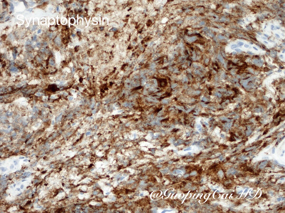 62/M with a large hilar lung mass. Aberrant expression of synaptophysin in epithelioid angiosarcoma #PulmonaryPath