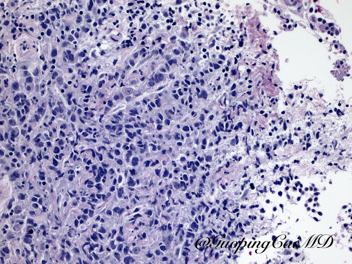 gcai1978's tweet image. 62/M with a large hilar lung mass. Aberrant expression of synaptophysin in epithelioid angiosarcoma #PulmonaryPath