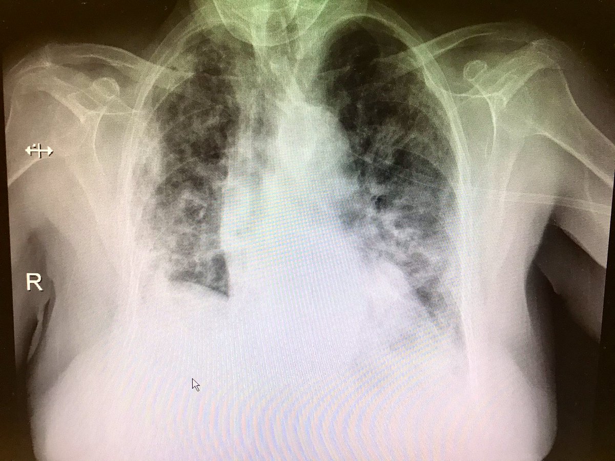 jc_trullas's tweet photo. El risc de rebrot baixa (615) i el Rt també (0.69)
Però a @hospiolot seguim igual. Molts ingressos, pacients crítics i defuncions 
#covid19garrotxa #covid19 https://t.co/8ayiPSuona