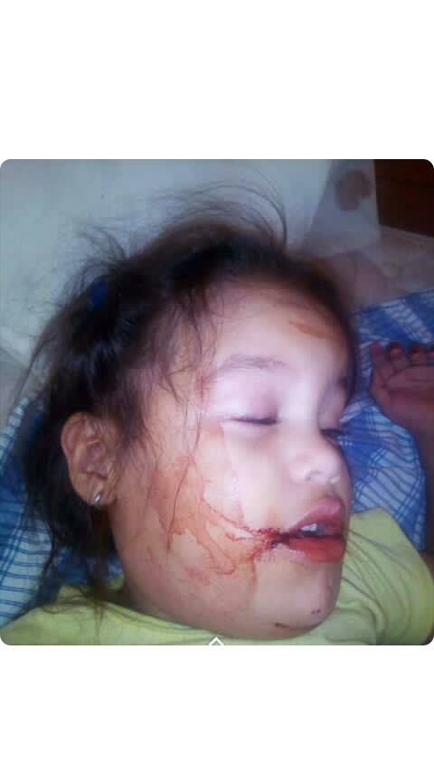 jose3045's tweet photo. Pido la ayuda para poder reunir el dinero de la operación mi hija que cuenta con un hidroma quístico en cuello y lengua y presenta fuerte sangrado todos los días @MamaLisVzla @nayrenchi @ConstruyamosPVE @lillacraa @TipsSabrina @_Futbolero_ @JoseAltuve27 
https://t.co/UG6i89fTqi https://t.co/anXd3puq5S