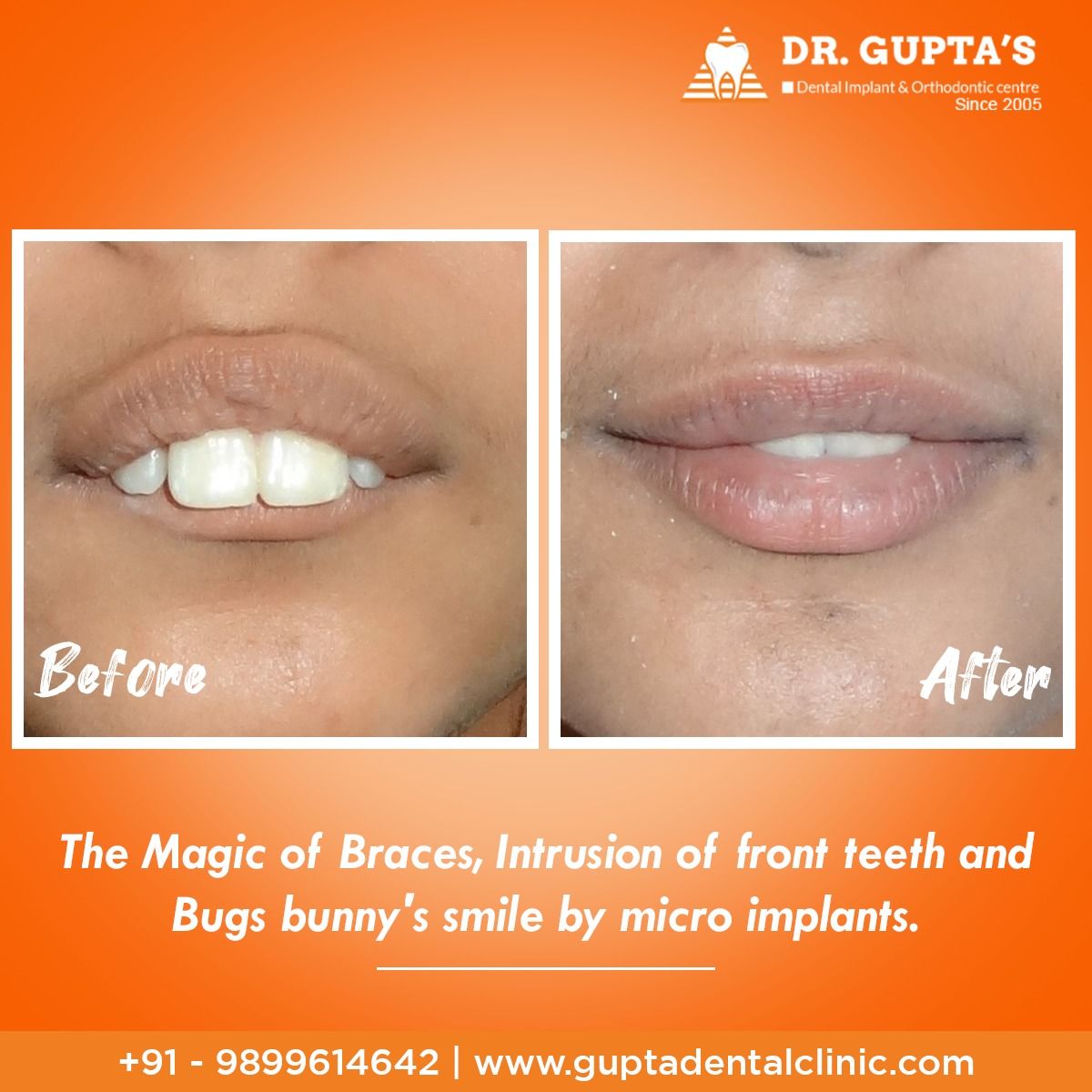 guptadentals's tweet image. The magic of #braces, an intrusion of #frontteeth and bugs bunny's #smile by #microimplants.
#Contactus at 9899614642 or visit guptadentalclinic.com for more details.
.
.
#InvisibleBraces #bracestreatment #toothache #toothpain #DentalProblem #beautifulsmile #teethproblems
