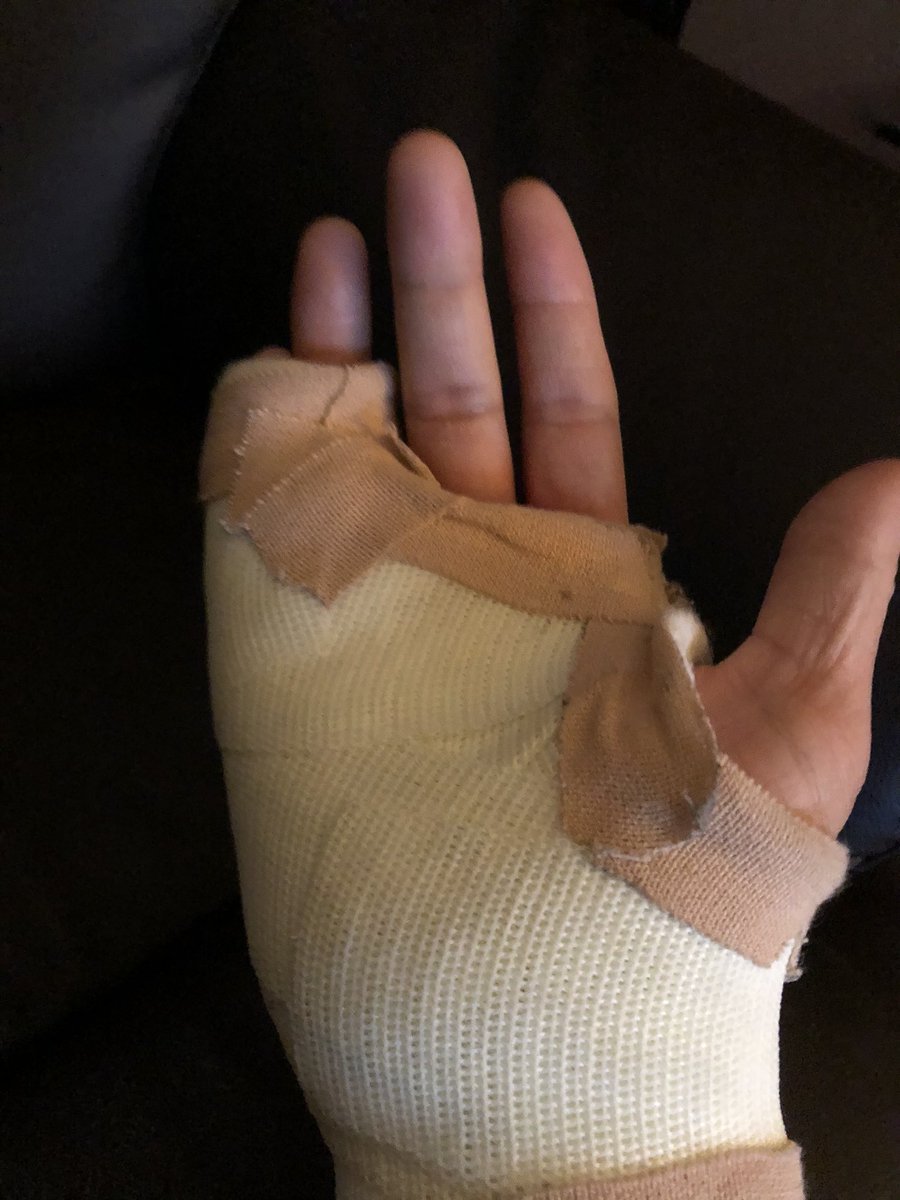 認定ハンド 両手 右手骨折2本有り 認定ハンド 両手 右手骨折2本有り