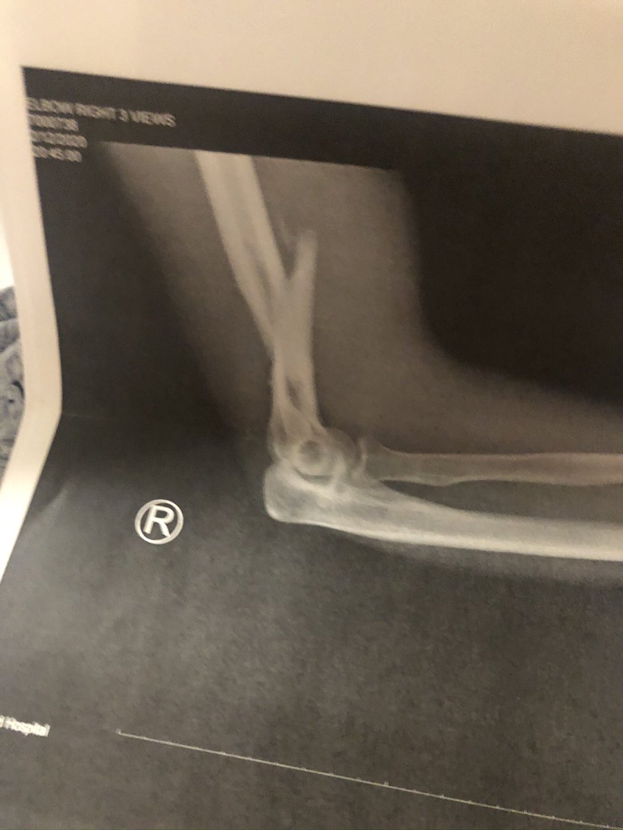Getwilde23's tweet photo. Bruh 1 year ago today I broke my arm throwing a dodgeball 😂😂 https://t.co/2YUZ0MwcRN