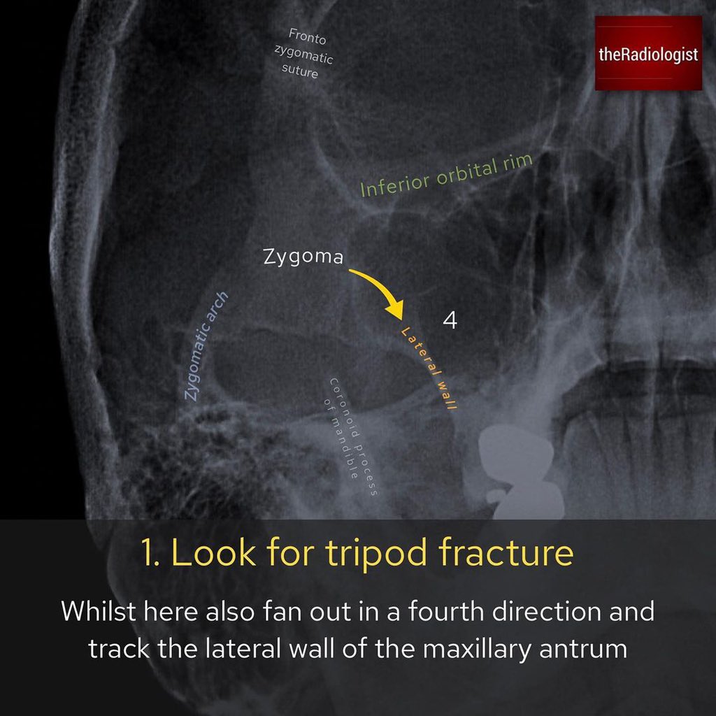 Mohammed Mahri محمد المهري The Fractures Are Usually More Complex On Ct And Can Extend To The Skull Base Definition Of A Quadripod Fracture Vary But Can Be Considered