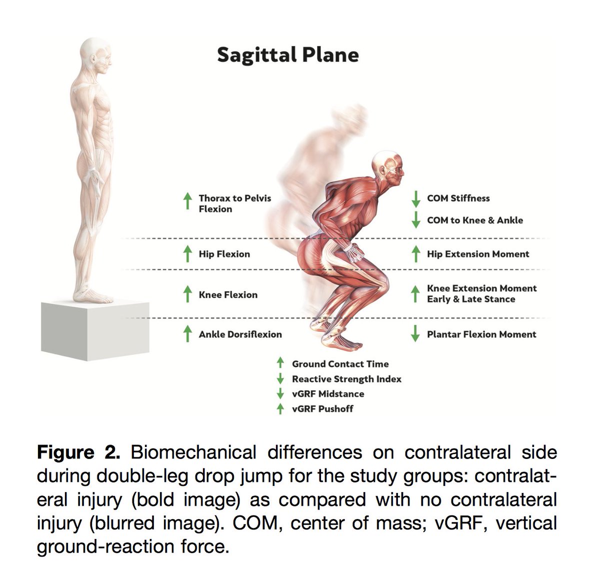 Delighted 2publish our latest #ACL paper 
Huge effort by all the team <a href="/SSCSantry/">UPMC Sports Surgery Clinic</a> <a href="/sscsportsmed/">SSC Sports Medicine</a> x many years

Largest prospective cohort CONTRA ACL inj w biomech Ax

🚨Spoiler
No Diff in Strength/Jump Height/COD LSI
Sagittal Plane incl stiffness NB!

tinyurl.com/2jmv78to
1/3👇