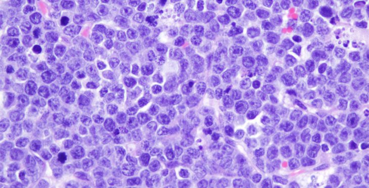 AlmudenaTimon's tweet photo. Cambio de paradigma en la forma de entender la #leucemia para centrarse en el desarrollo de estrategias de prevención, en lugar de en vías para tratar las leucemias una vez que se han producido.

Nueva publicación del @CICancer_com y del @CBMSO_CSIC_UAM 
https://t.co/LXVHRWKLBf https://t.co/lNvOOLX3JB