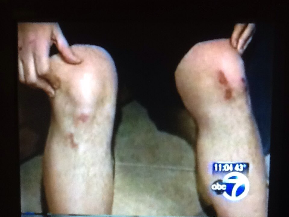 22-My knees took some damage too. My weight + Gelman's weight + a hard subway floor equals this. Again, MY knees, NOT  #NYPD Officer Howell's