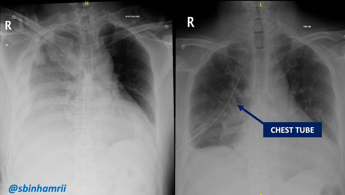 🔴#Hemothorax Post #Supine US-Guided #PCNL 
🔴Droped 4 g/dl 
😕I did not see it coming after 300 cases 
🔴Yet, it happened 
🔴A real nightmare 
✅Be humble
<a href="/PETRAurogroup/">PETRA</a> <a href="/PEARLSendouro/">PEARLS</a>