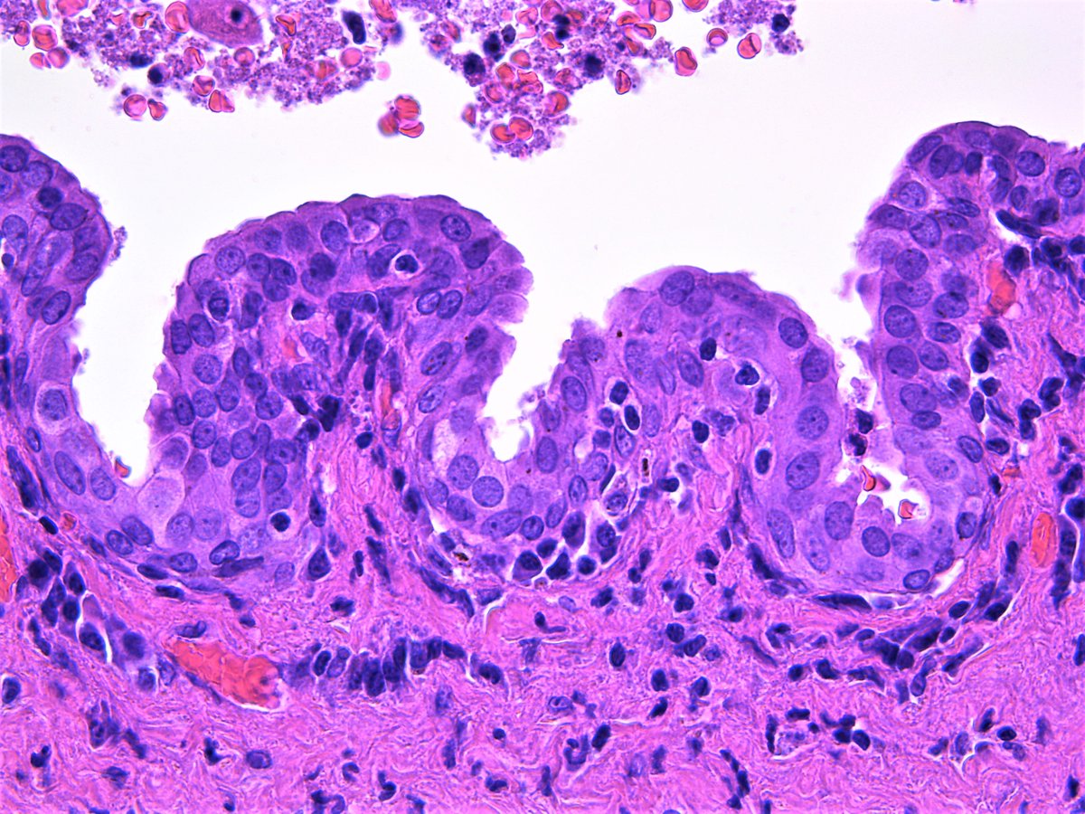 Bartholin's cyst.  #Pathology #Pathologist #Gynpath