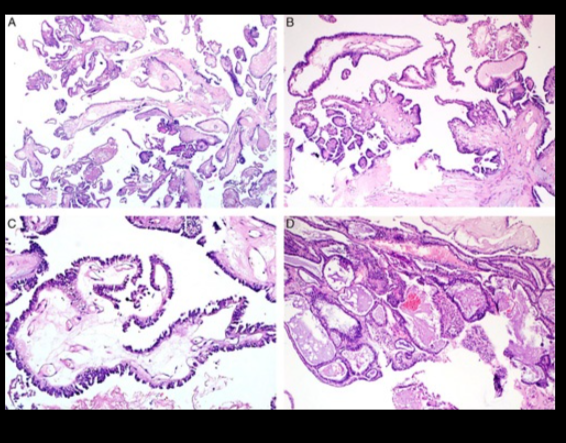 mzehraordulu's tweet photo. Speaking of SBTs and arborizing pattern, check out this case report @IJGynP @ISGynP
An endometrial endometrioid adenoCA with similar growth pattern and KRAS mutation, which are common in SBTs though can be seen in endometrial tumors.#genotypephenotype
https://t.co/xUZSWkXNnE https://t.co/0xAkjlWq9D