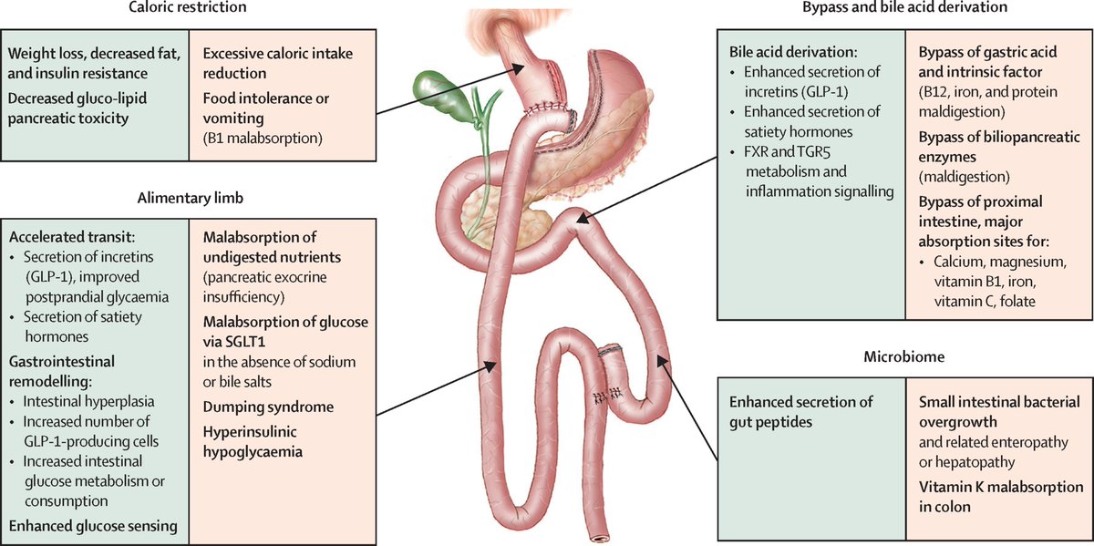 New Review - Nuzzo et al - Prevention and treatment of nutritional complications after bariatric surgery

thelancet.com/journals/langa…

#gitwitter <a href="/AlexandreNuzzo/">Alexandre Nuzzo</a> <a href="/franciscajoly/">Joly Francisca</a> #bariatricsurgery #obesity