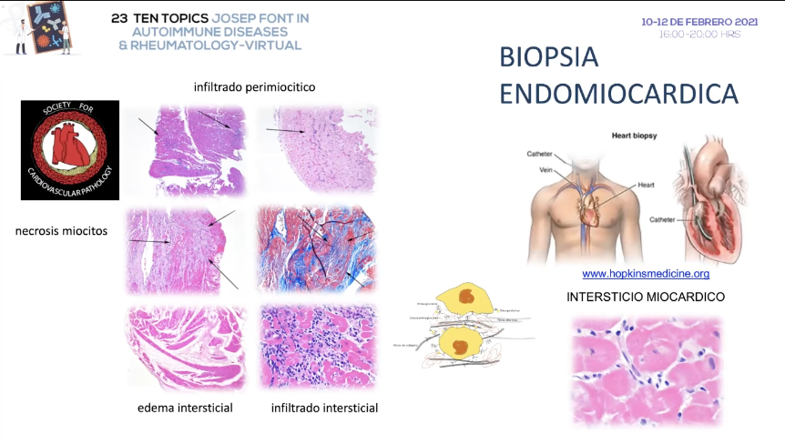 GEAS_SEMI's tweet photo. #Miocarditis intersticial ¿Una manifestación más del síndrome #antisintetasa? Dr. Selva  #23TenTopics #SEMITuit

La biopsia endomiocárdica es una técnica agresiva. Mayor experiencia en pacientes trasplantados https://t.co/uiHHr2vDfv