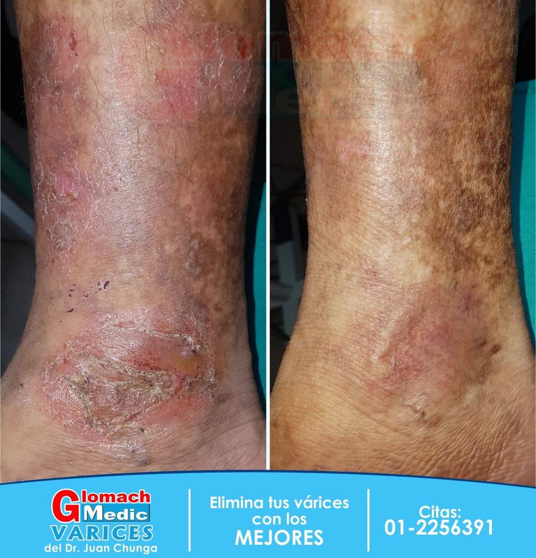 VaricesGlomach's tweet photo. En Glomach Medic encuentra le mejor solución para tu enfermedad varicosa y recupera la salud de tus piernas. #Novarices
#piernassanas #flebologia #escleroterapia #sclerotherapy https://t.co/2r1bwuuplK
