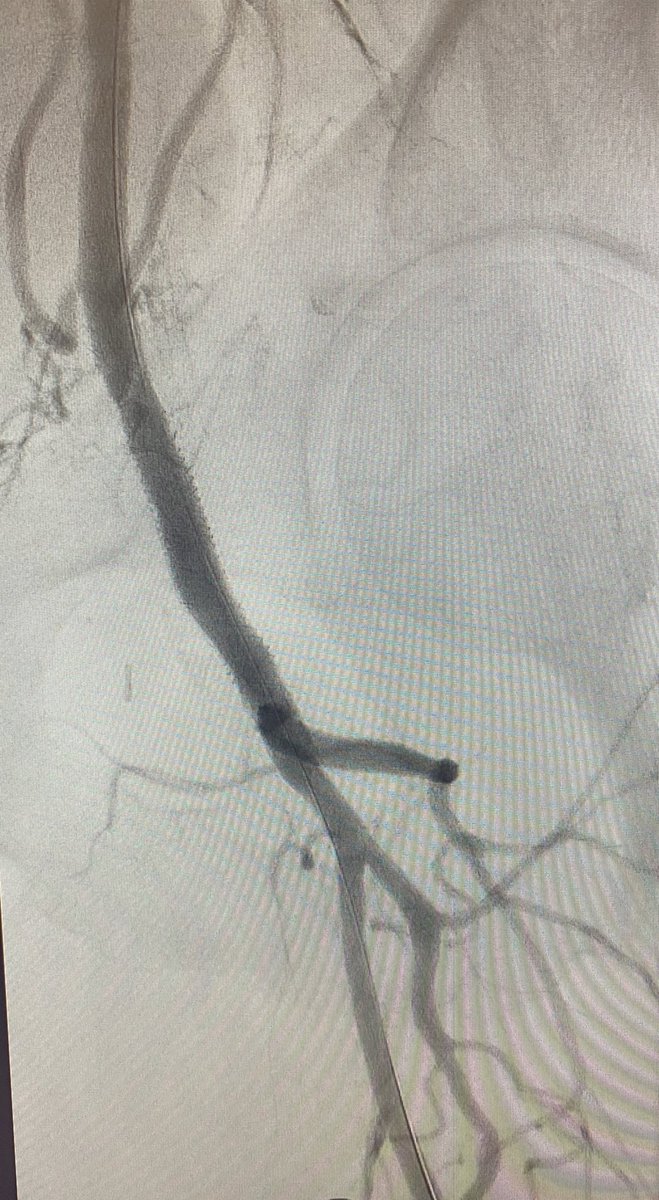 81 yo with W1I3FI0, hx of endart, followed by fem pop. BPG occluded, CFA occluded, SFA occluded. TBI 0.15. Redo redo groin or bypass vs endo CFA plasty? I decided to get the profunda back in play, can always bypass to BK pop from the profunda - thoughts?<a href="/BCM_Surgery/">BCM_Surgery</a> <a href="/hendolat/">Hendolat</a>