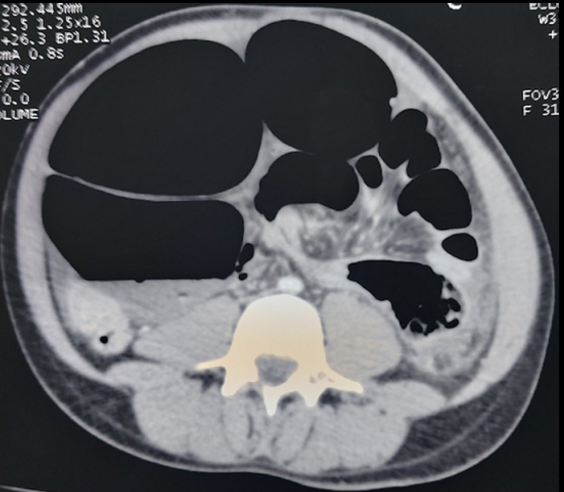10bladeae's tweet photo. The diameter on that colon though! 😰 can you #figureitout ? https://t.co/3JqddPWbQ1 << this has the intra op findings and full case!! Enjoy! #FIOF #10blade #some4surgery #surgery #surgicalresident #colon #Dubai #UAE #MedTwitter https://t.co/rnF4k3t07I