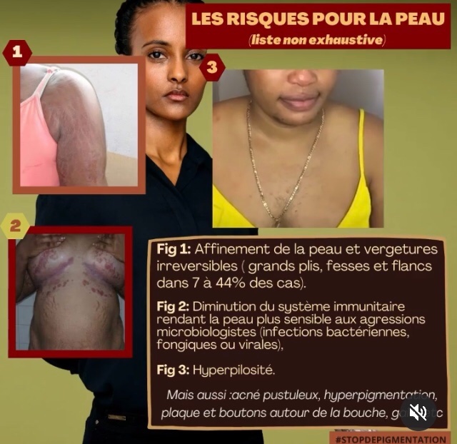 Stopdepig's tweet image. #StopDepigmentation 🖤