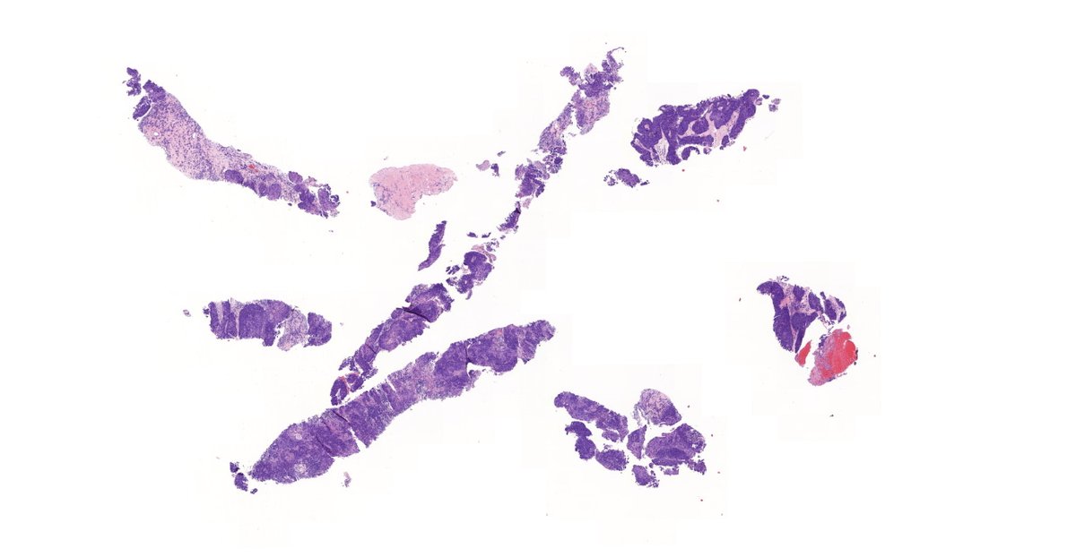 Anterior mediastinum, Female adult #pulmpath  #surgpath  #pathtwitter