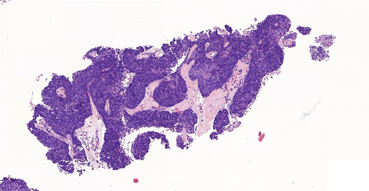 Anterior mediastinum, Female adult #pulmpath  #surgpath  #pathtwitter