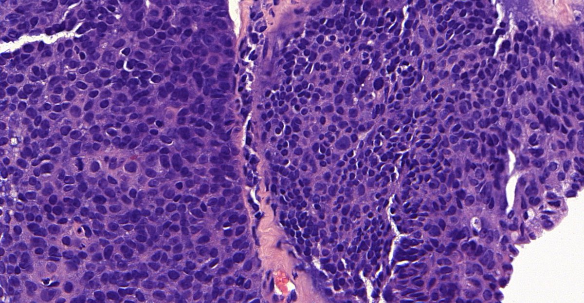 Anterior mediastinum, Female adult #pulmpath  #surgpath  #pathtwitter