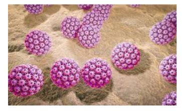 Los condilomas genitales pueden presentarse en vulva, periné, regiones perianales, anales , vulvalres, cavidad oral, vaginales y en cuello uterino entre muchas otras.Son producidos sólo por vph no oncogénicos 6 y 11.