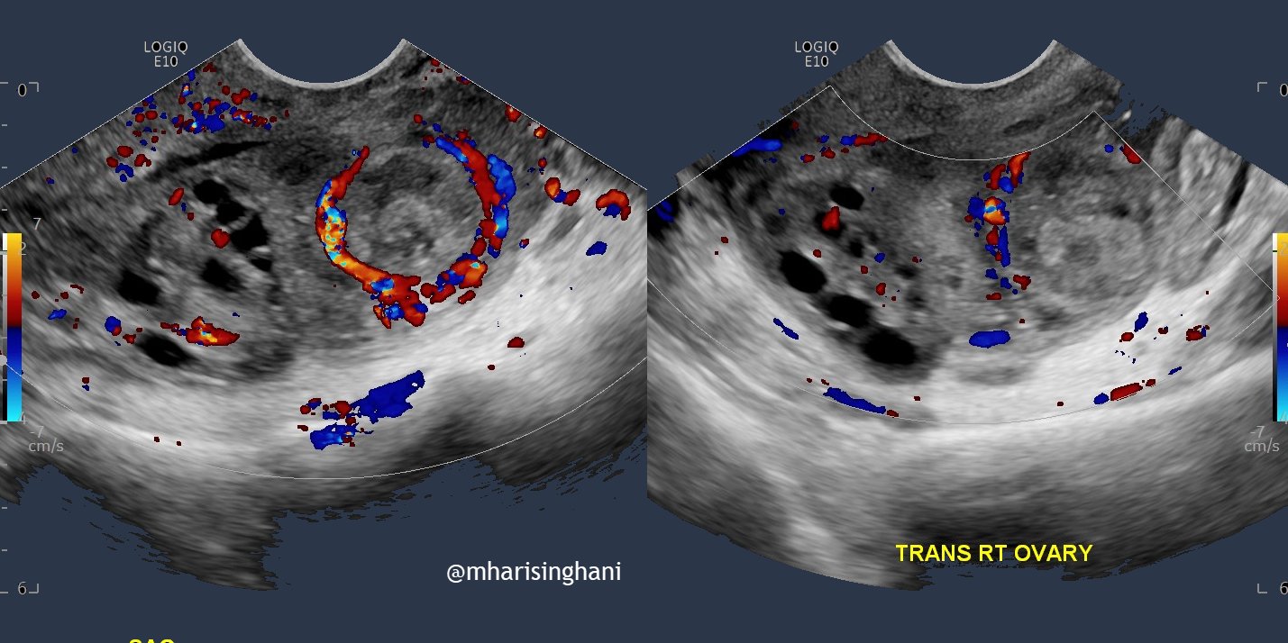 Imaging of Early Obstetric Emergencies | SpringerLink