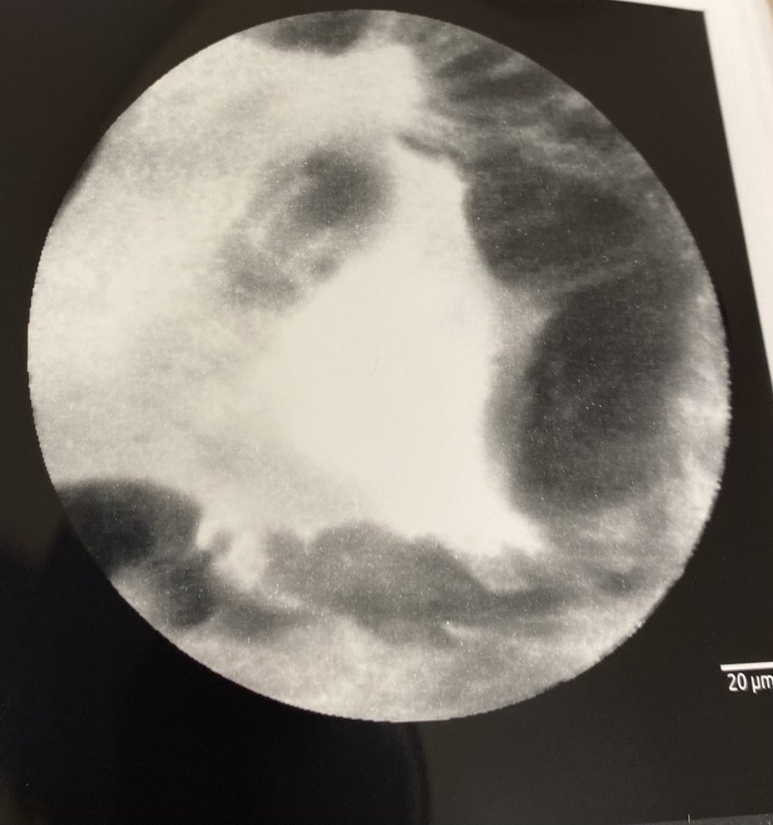 fahedjulien's tweet photo. Pushing the boundries with #cellvizio live #endomicroscopy in #barrettsesophagus #gastroenterology #gi #endoscopy #pathology  #cancerprevention #cancer https://t.co/PVXRWcnJSk