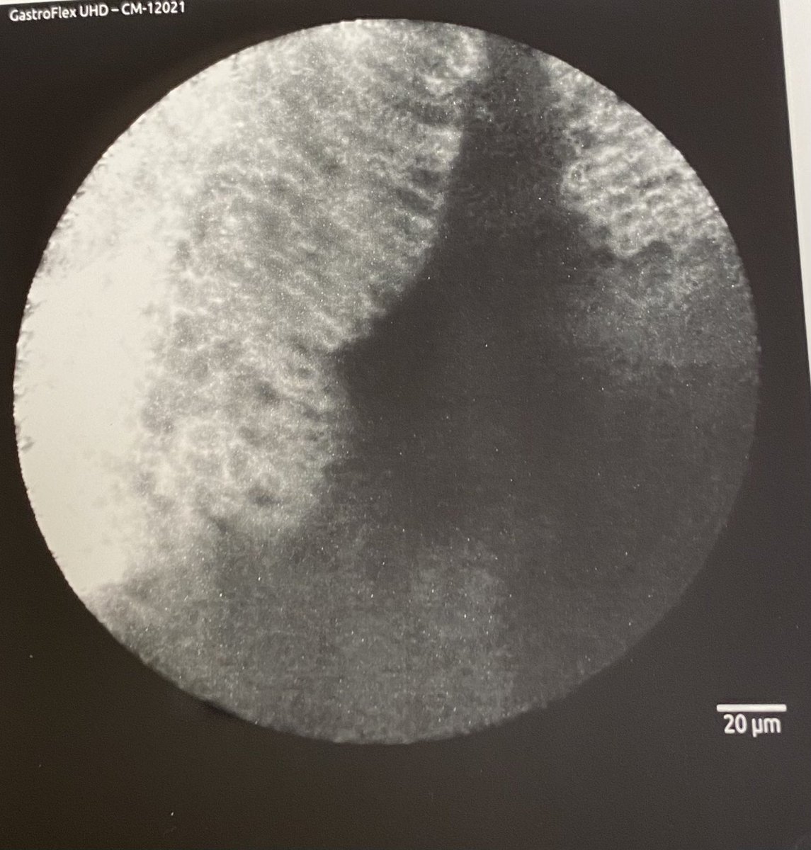 fahedjulien's tweet photo. Pushing the boundries with #cellvizio live #endomicroscopy in #barrettsesophagus #gastroenterology #gi #endoscopy #pathology  #cancerprevention #cancer https://t.co/PVXRWcnJSk