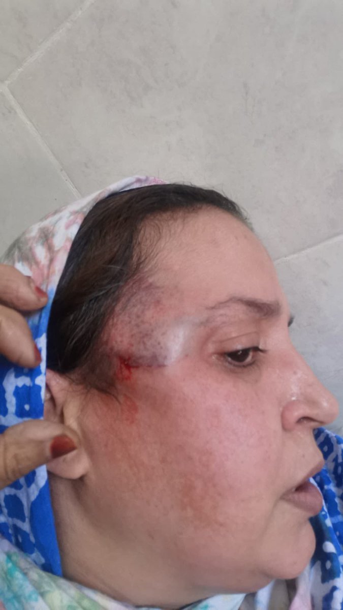 La brave militante sahraouie Soltana Khaya membre <a href="/IsacomSaharaui/">ISACOM</a> victime ce matin d’ une agression violente de la part de la police de l’occupant marocain, ça laisse très claire et nette la situation alarmante des sahraouis aux territoires occupés <a href="/mbachelet/">Michelle Bachelet</a> <a href="/UN/">United Nations</a> <a href="/MaryLawlorhrds/">Mary Lawlor UN Special Rapporteur HRDs</a>