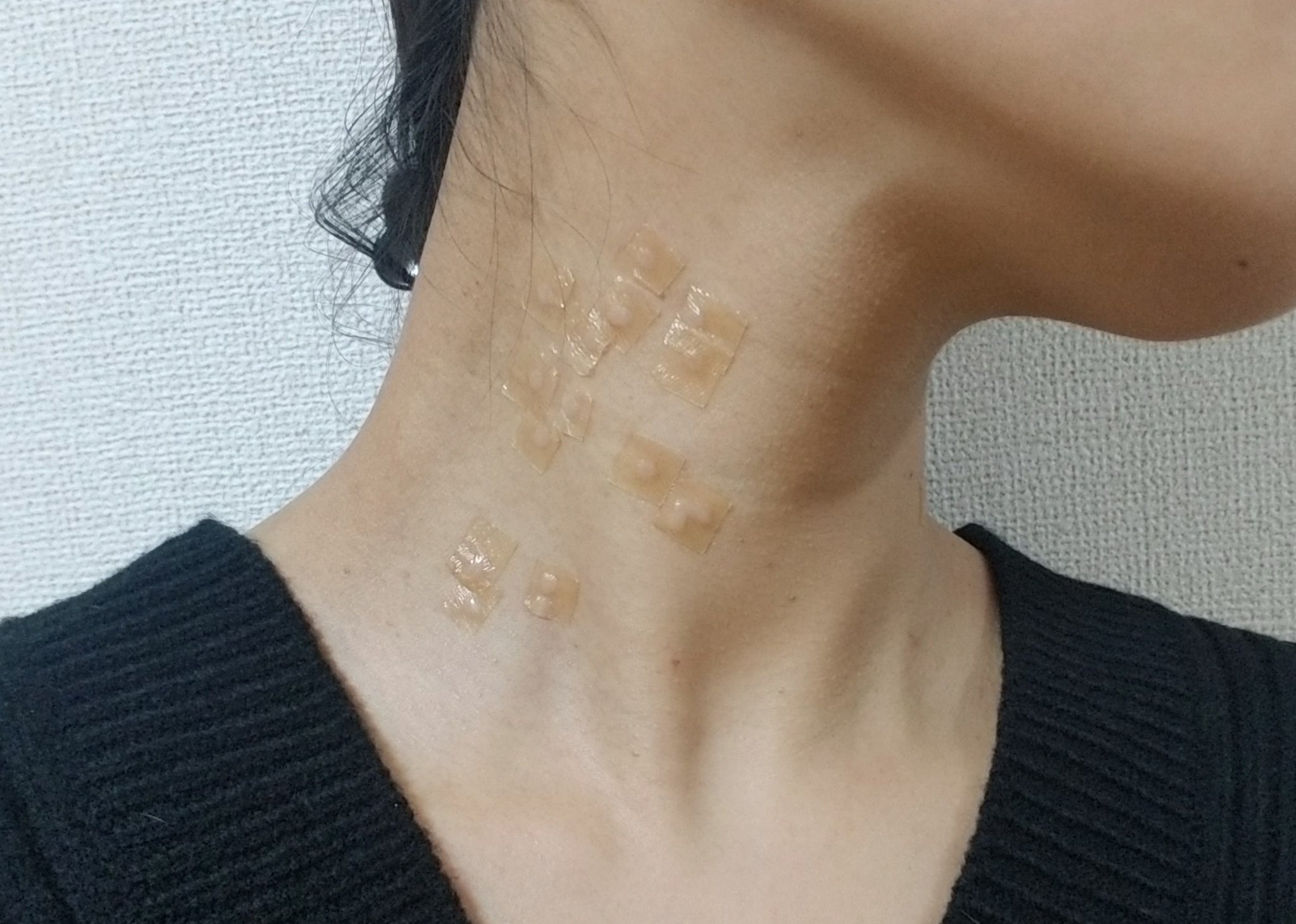 M I K I O 今日は 美容皮膚科にて首イボ 老人性イボ をレーザーで取ってもらいました この歳で結構気になるので できやすい体質みたい 保険適用で2 500円でお釣りが来たので イボポロリみたいな変な薬買うより絶対いい 夏に向けてデコルテを