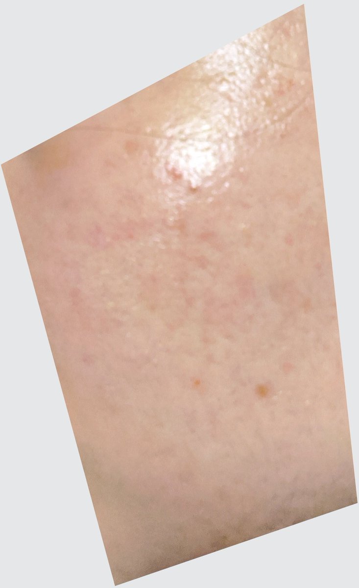 Ena 記録 36日目追記 結局赤白ニキビ 白ニキビ跡が散発的に発疹状に 薬投下 ニキビ 及び発疹 ちょっとかゆみがある などは収まる 常時両頬が赤い 腫れはない顔のふちが少しかゆい時がある 現在はちょっと左頬の一部が赤く残る程度