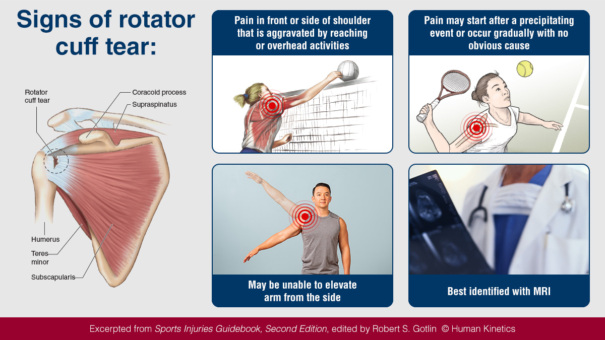 Human_Kinetics's tweet image. Rotator cuff tears usually occur in athletes over age 40 who have a long history of participation in repetitive overhead sports. #sportinjury #returntoaction #sportsmed

Check out Sports Injuries Guidebook, Second Edition to learn more ecs.page.link/2uKjS