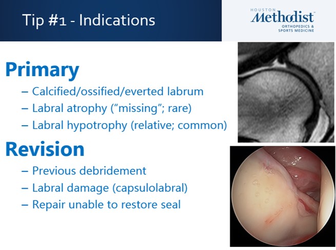 JoshuaHarrisMD's tweet image. 2021 #Vail #Hip Symposium!!! Catch our annual meeting virtually on March 5 and 12! What a fun group to work with this year. Thank you @smithnephew - #labrum #FAI #reconstruction #dysplasia #arthroscopy #preservation