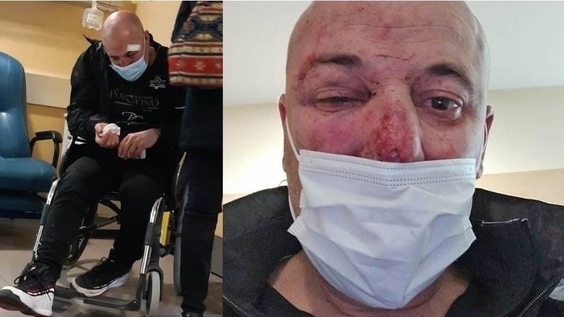 FonsiLoaiza's tweet photo. Estos policías agredieron brutalmente a este vecino de Linares y a su hija menor. Tiene nariz rota y fisura en la córnea. Mientras, el ministro Marlaska sigue sin decir nada. El Tribunal de Derechos Humanos condenó a España por no investigar torturas en 7 causas dirigidas por él. https://t.co/MJAwPyyiWT