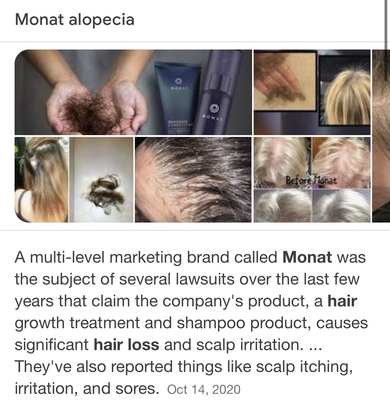 Monat hair loss lawsuits deals