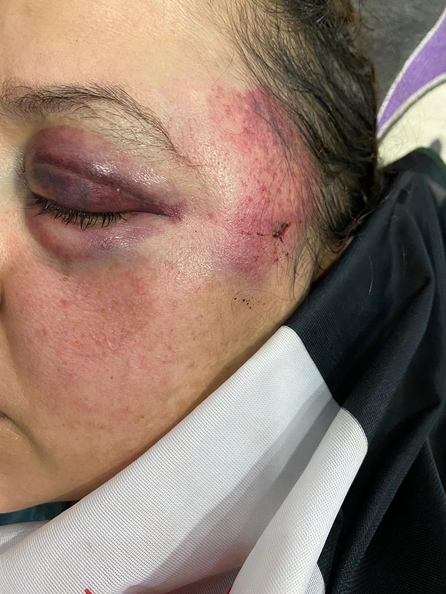 <a href="/mbachelet/">Michelle Bachelet</a> <a href="/antonioguterres/">António Guterres</a> La militante sahraouie Sultana Khaya membre <a href="/IsacomSaharaui/">ISACOM</a> a besoin de votre urgente intervention pour qu’elle puisse voyager à l’étranger pour se soigner des séquelles de l’ agression violente de l’occupant marocain dont a été victime ce matin