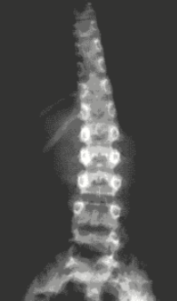 2/- Lumbar X ray shows scoliosis w/ right concavity- Bone scintigraphy: pathological uptake in L1- PCR: 38.3 mg/dl (NL 0-5)