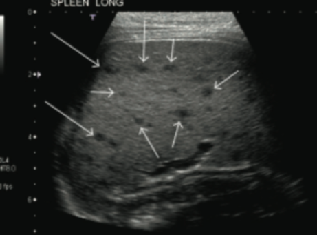 3/- Spleen ultrasound showed multiple hypoechoic lesions suggestive of microabscess.
