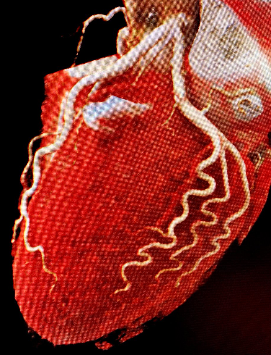 AlohaMeaveMD's tweet image. Coronary tortuosity frequently seen in women #EnfermedadCardiovascularEnLaMujer  #WomenHeartDisease #WhyCCT #ICVincichFellows