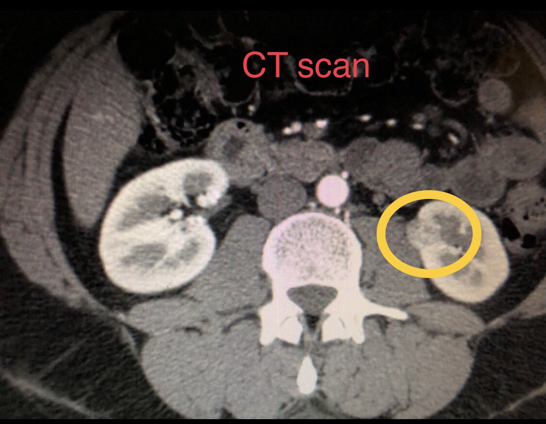 It turns out that getting COVID may have saved my life. It made me take chest pain & shortness of breath seriously enough to get a CT where they found a kidney tumor. MRI confirmed. 90% it’s renal cell carcinoma (cancer) but easily curable w/ surgery. It’s been a crazy 2 weeks.