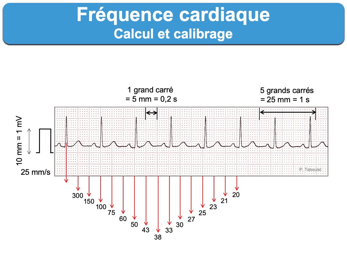 - Pour calculer la FC il faut diviser 300 par le nombre de grands carreaux séparant 2 complexes QRS, de R à R. Ou sinon retenir la technique des 300, 150, 100…